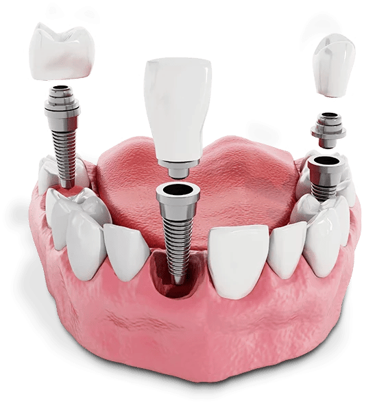 dental implant model