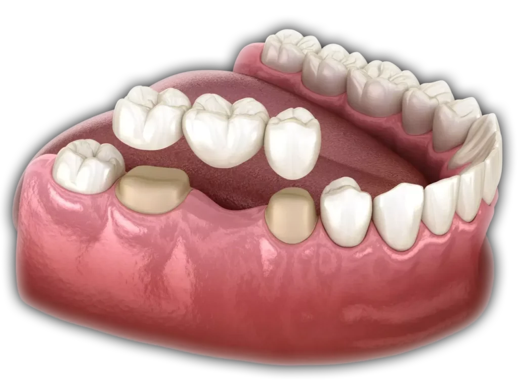 graphic of a dental bridge