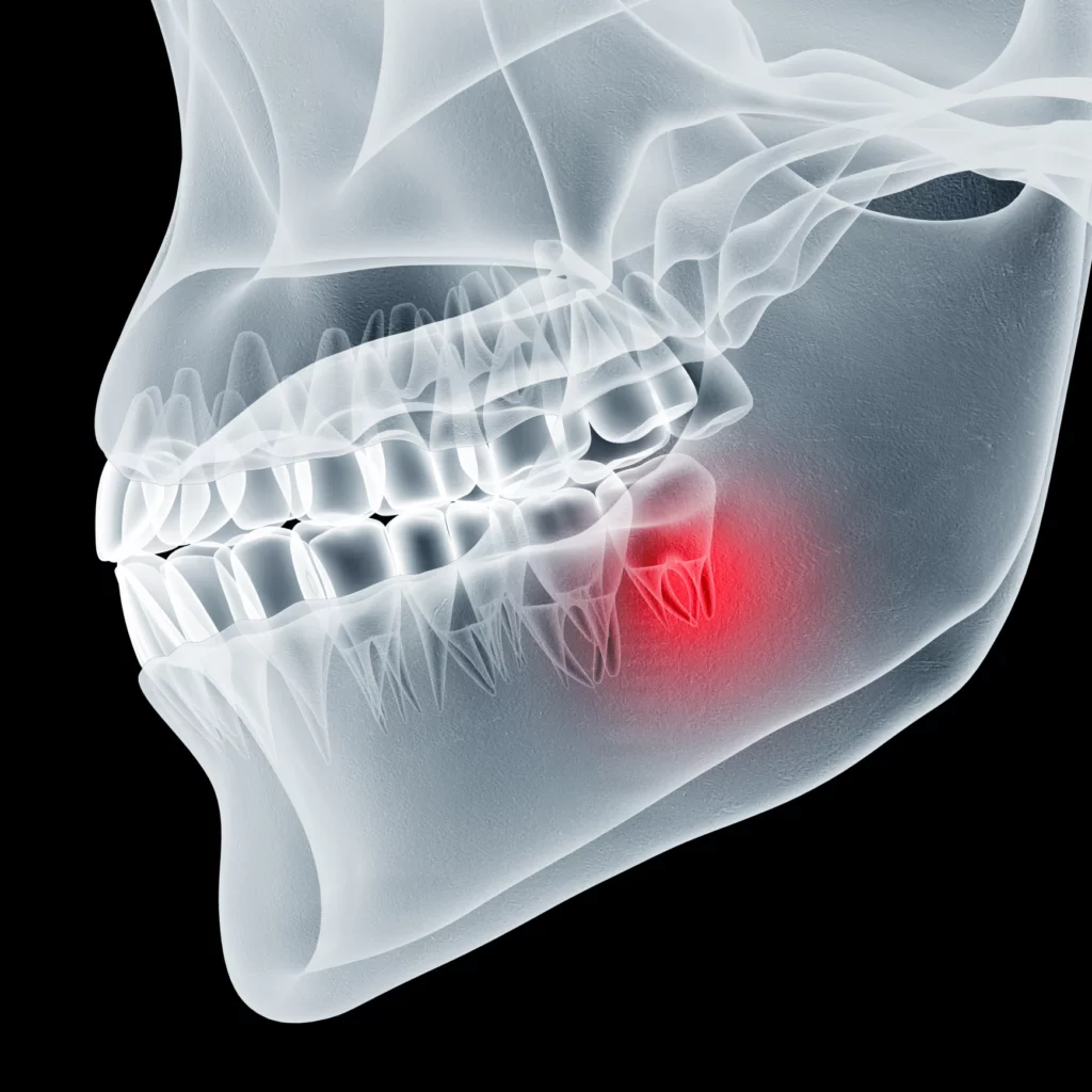 wisdom teeth removal in CITY, STATE