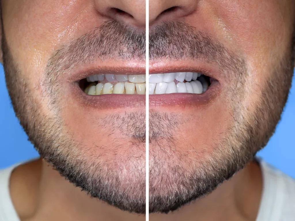 before and after professional teeth whitening at dentist