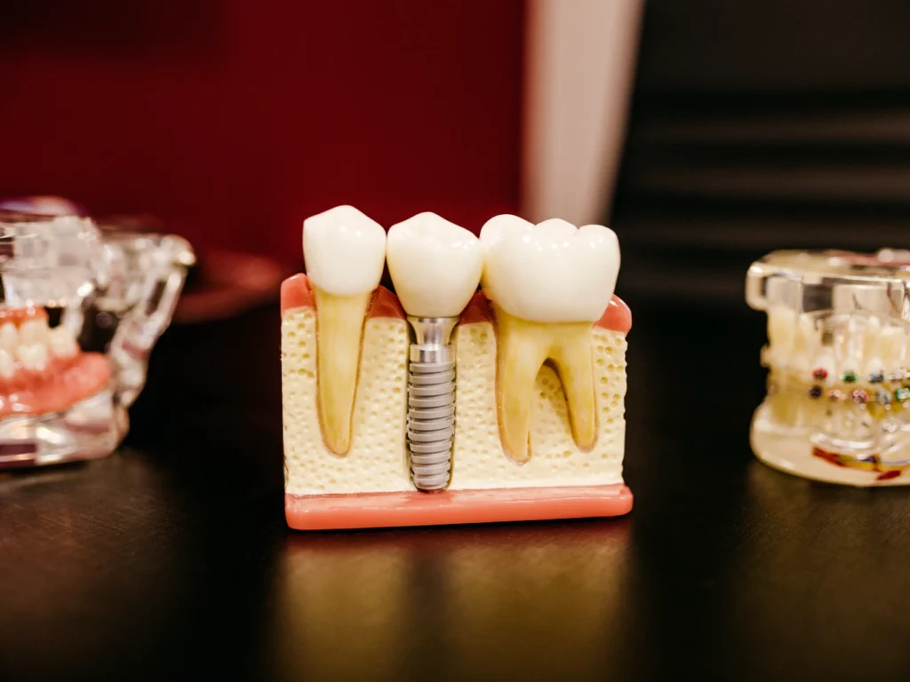 model of a single tooth dental implant | cost of dental implants in CITY, STATE